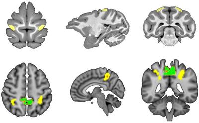 Corresponding anatomical of the macaque superior parietal lobule areas 5 (PE) subdivision reveal similar connectivity patterns with humans